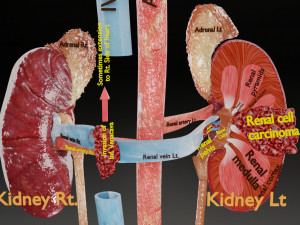 Renal cell carcinoma 3D-Modell